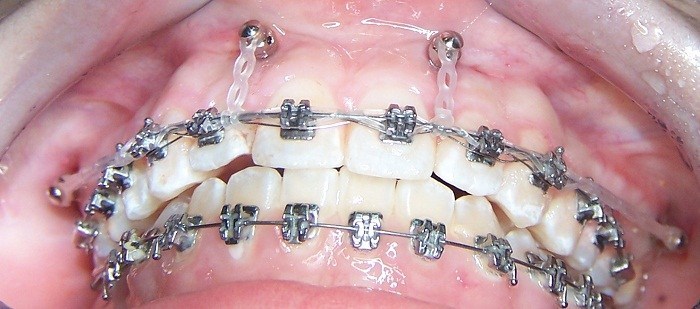 Phương Pháp Đánh Lún Là Gì? Lúc Nào Cần Phải Đánh Lún? 12 danh lun rang