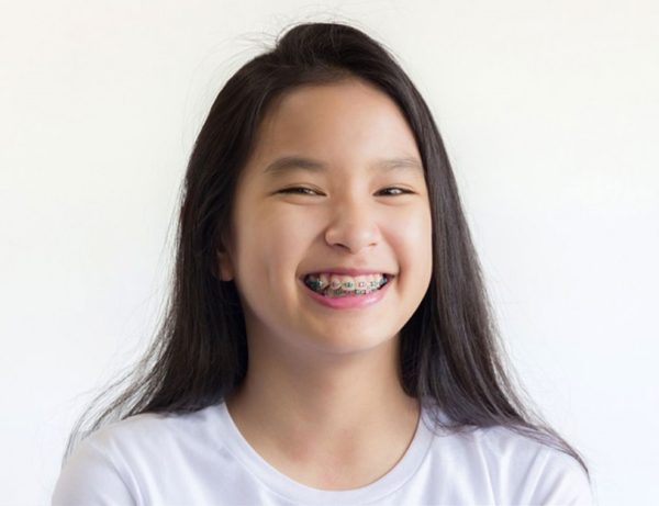 Phương Pháp Đánh Lún Là Gì? Lúc Nào Cần Phải Đánh Lún? 10 nan chinh rang cho tre em o do tuoi nao hieu qua nhat 600x461 1