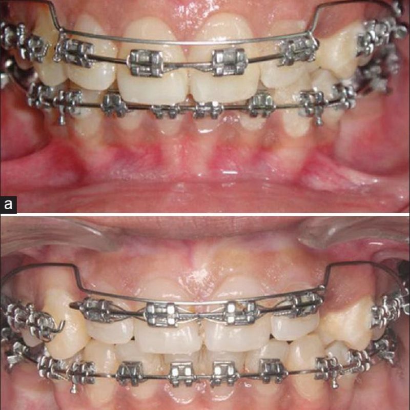 Phương Pháp Đánh Lún Là Gì? Lúc Nào Cần Phải Đánh Lún? 11 phuong phap danh lun trong chinh nha 10