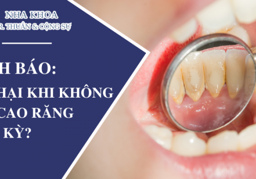 CẢNH BÁO: Tác Hại Khi Không Lấy Cao Răng Định Kỳ?