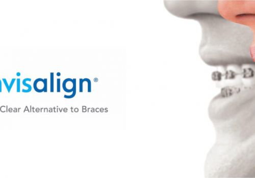 Ưu nhược điểm của niềng răng trong suốt và cách khắc phục nhược điểm?