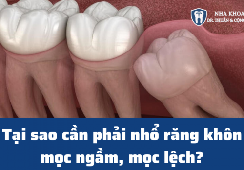 Tại sao cần phải nhổ răng khôn mọc ngầm, mọc lệch?