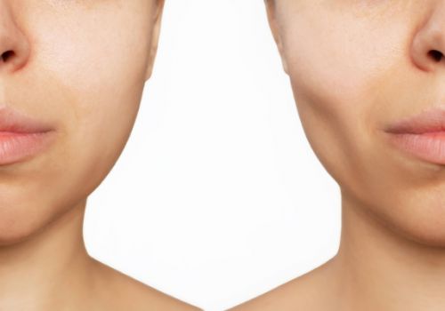 TẠI SAO KHI NIỀNG RĂNG THƯỜNG GÂY HÓP MÁ? NGUYÊN NHÂN VÀ BIỆN PHÁP KHẮC PHỤC