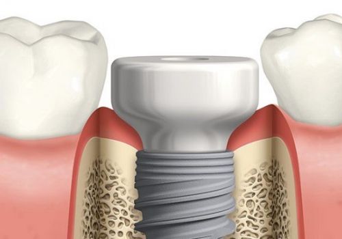 Tại Sao Cấy Ghép Implant Cần Đặt Healing?