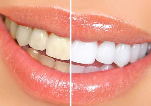 Những trường hợp nên và không nên tẩy trắng răng