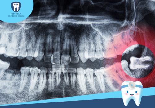 Khi nào nên nhổ răng khôn? Các bước của nhổ răng khôn