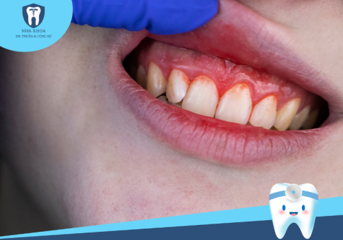 Dấu hiệu nhận biết viêm nha chu? Cách điều trị viêm nha chu tại nhà
