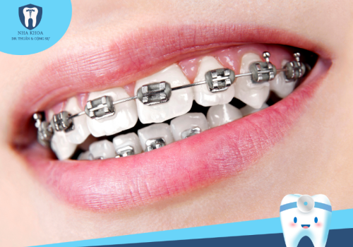 Ưu điểm, nhược điểm và những lưu ý khi niềng răng mắc cài
