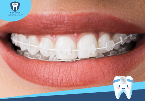 Top 3 dịch vụ niềng răng phổ biến tại nha khoa uy tín ở Ninh Bình