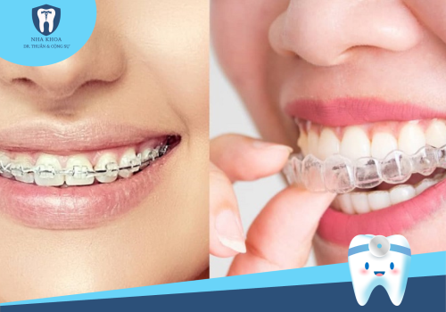 NIỀNG RĂNG MẮC CÀI TRONG SUỐT LÀ GÌ? ƯU VÀ NHƯỢC ĐIỂM