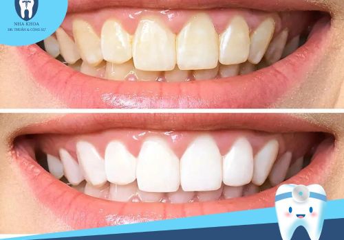 Hướng dẫn 18 cách làm trắng răng tại nhà đơn giản hiệu quả
