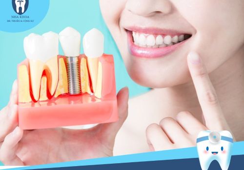 Cấy ghép implant phù hợp với ai? Chi phí thực hiện là bao nhiêu?