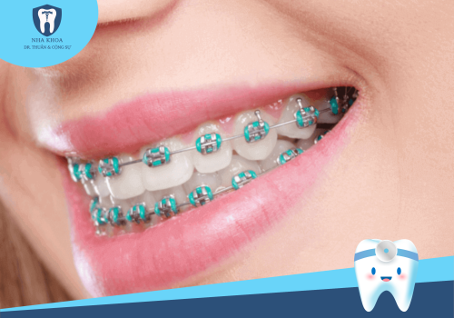 Niềng răng mắc cài kim loại thường: Lựa chọn hợp lý cho nụ cười xinh