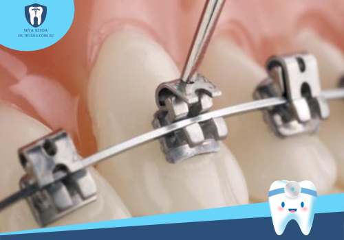 Niềng răng mắc cài kim loại tự động sở hữu ưu điểm, lợi ích gì?