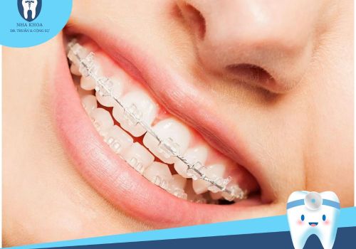 Niềng răng mắc cài sứ là gì? Phù hợp với ai? Giá bao nhiêu?