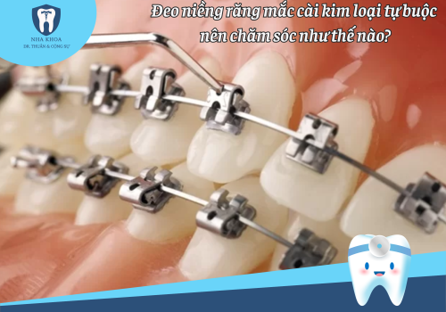 Đeo niềng răng mắc cài kim loại tự buộc nên chăm sóc như thế nào?