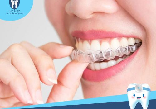 Niềng răng trong suốt giá bao nhiêu? Thời gian niềng bao lâu?