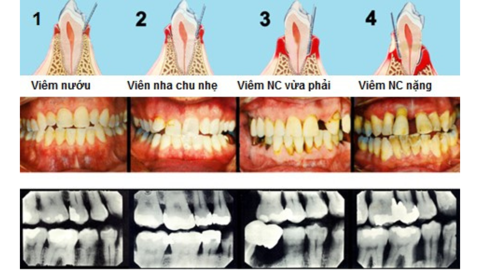 điều trị nha nhu