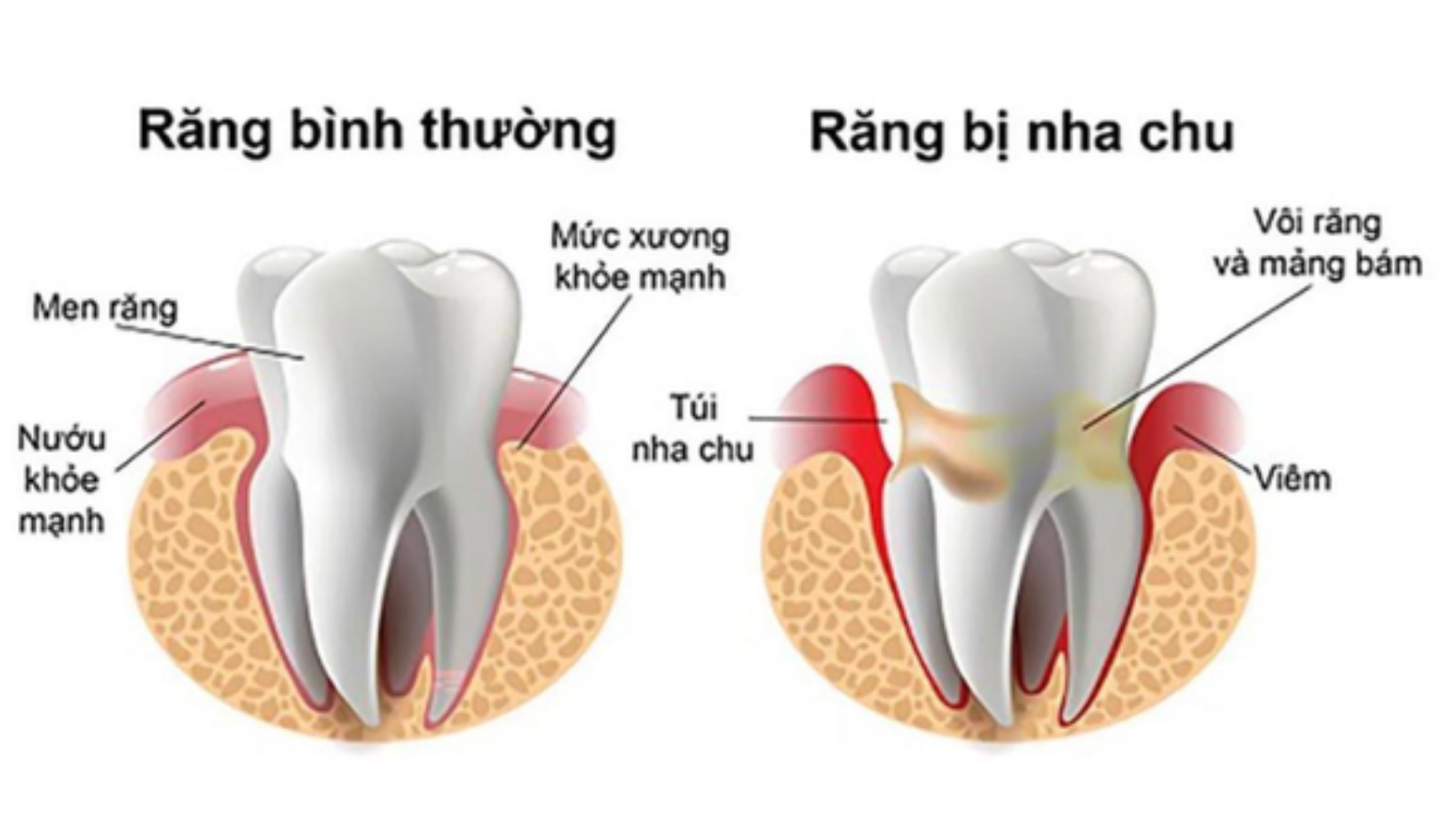 điều trị nha nhu