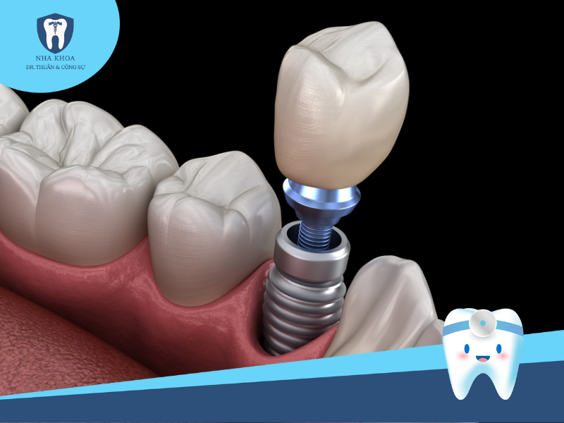 Cấy ghép răng implant đơn lẻ