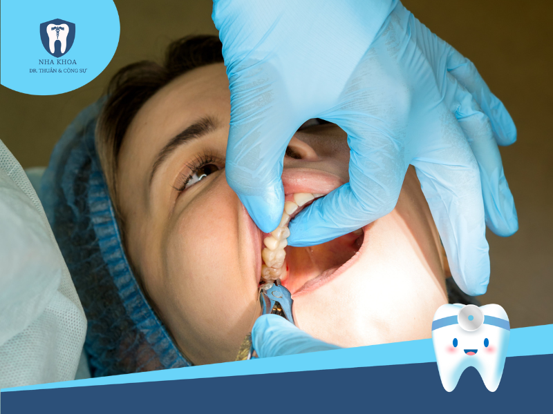 Nha sĩ đang nhổ răng khôn
