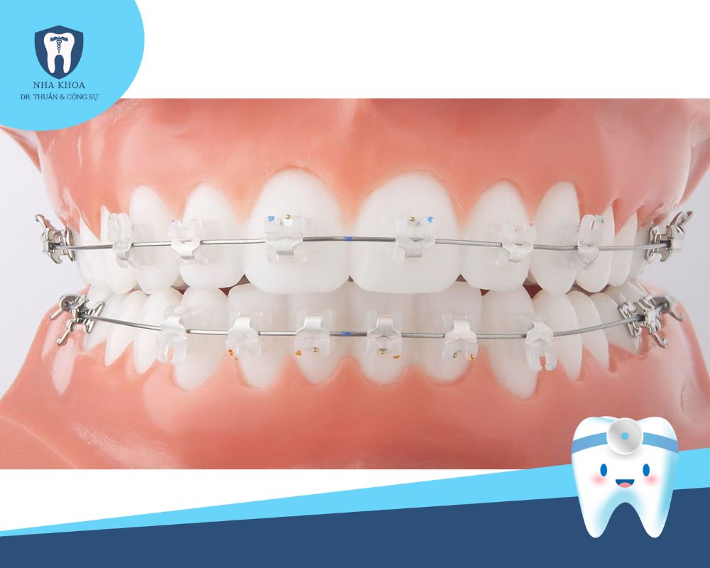 Niềng răng mắc cài sứ cung kim loại