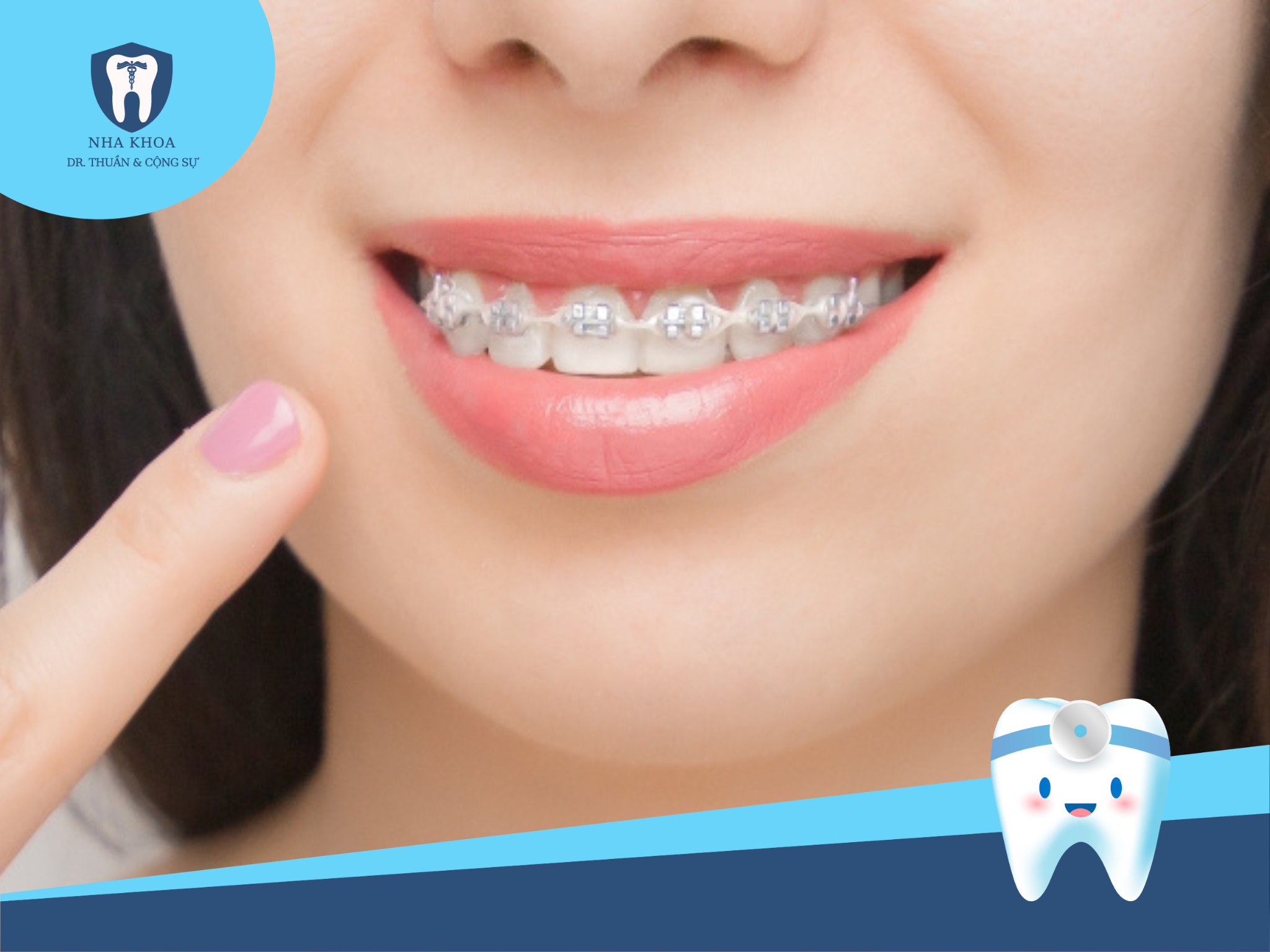 Những nhược điểm khi bạn niềng răng mắc cài trong suốt