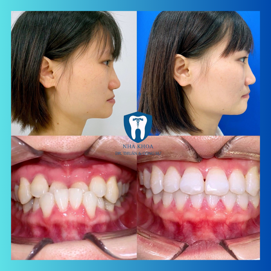 Trải nghiệm dịch vụ niềng năng tại nha khoa dr thuần 3