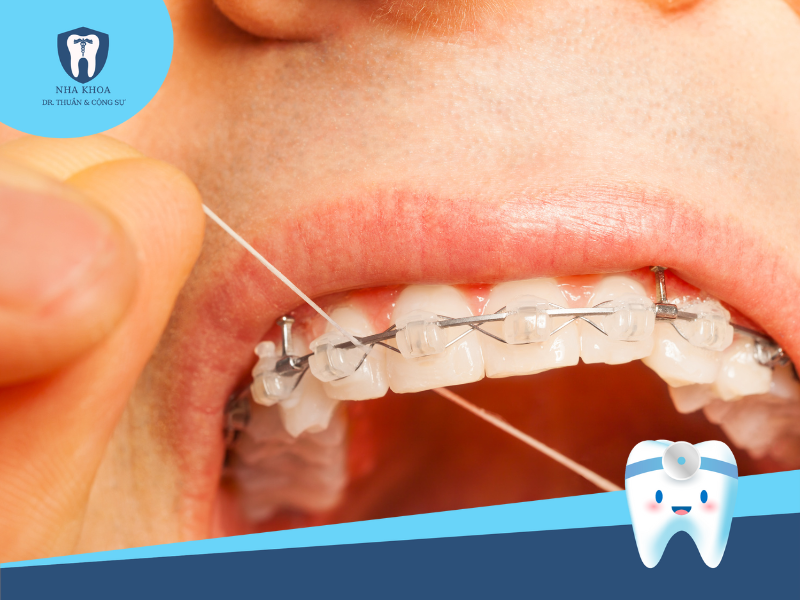 Vệ sinh răng miệng bằng chỉ nha khoa