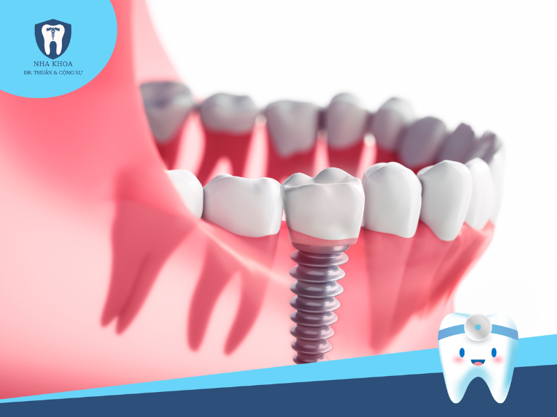cấy ghép răng implant