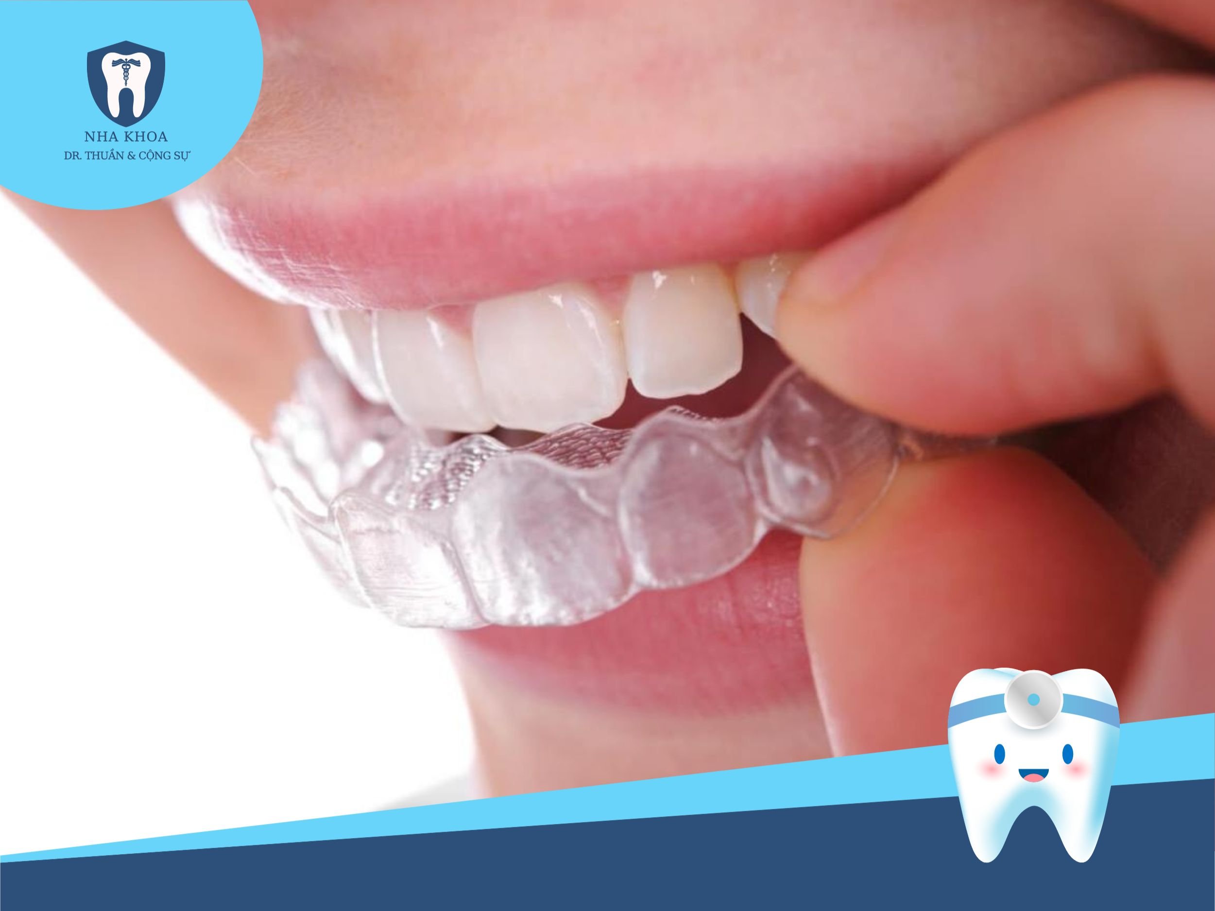 Khay niềng răng trong suốt mang đến nhiều ưu điểm vượt trội