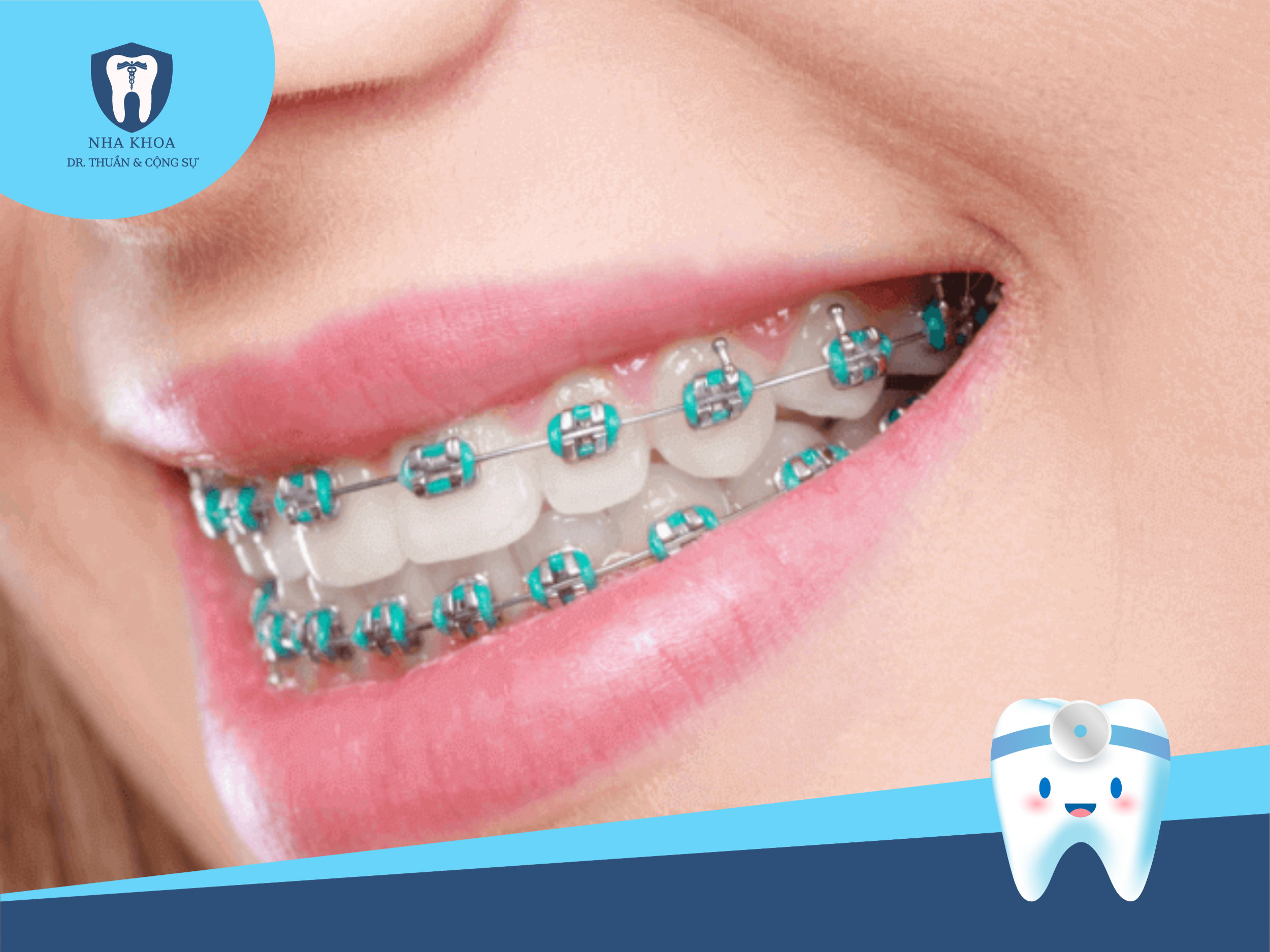 mac-cai-kim-loai-thuong-1