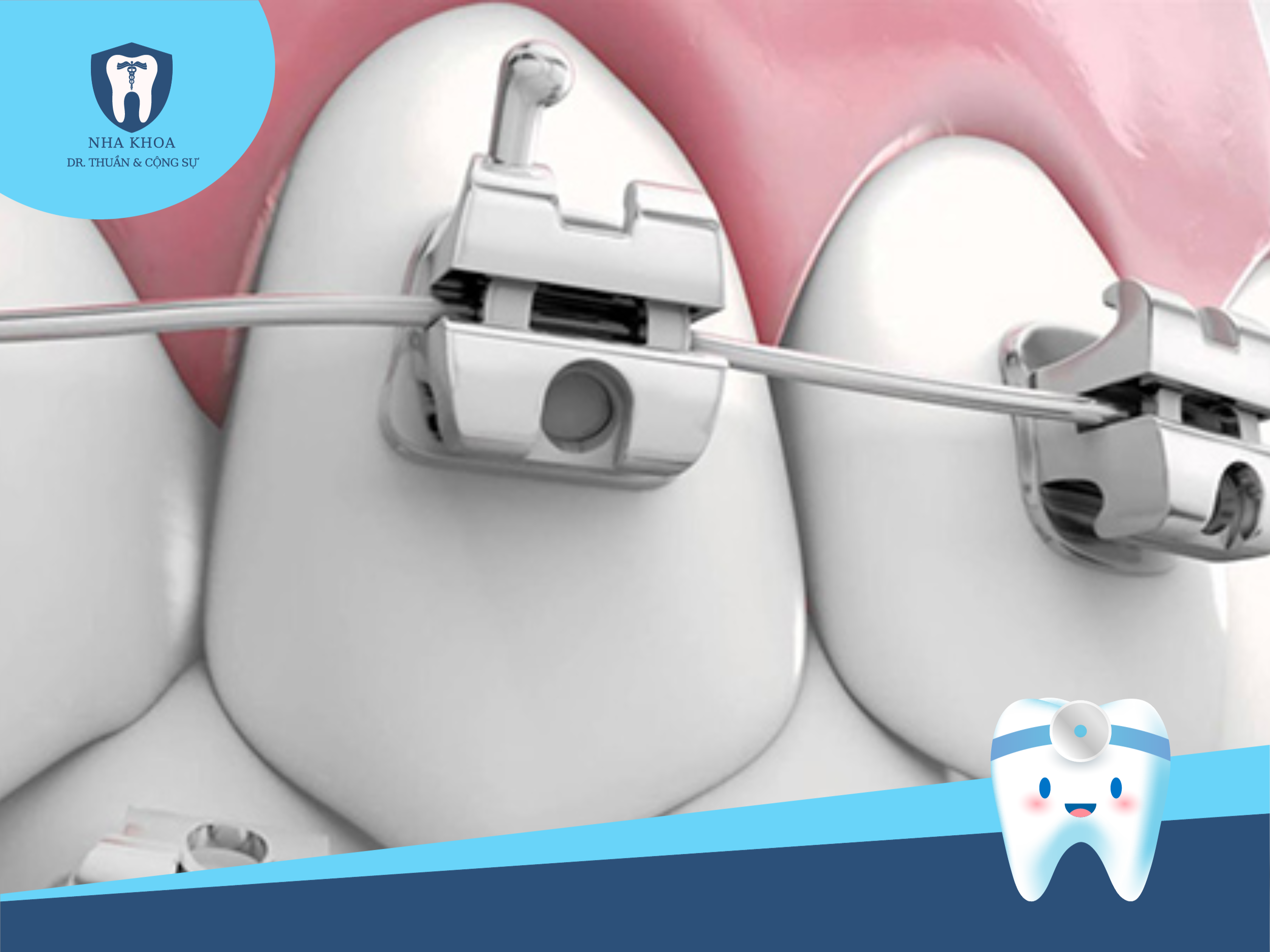 mac-cai-kim-loai-tu-dong-2