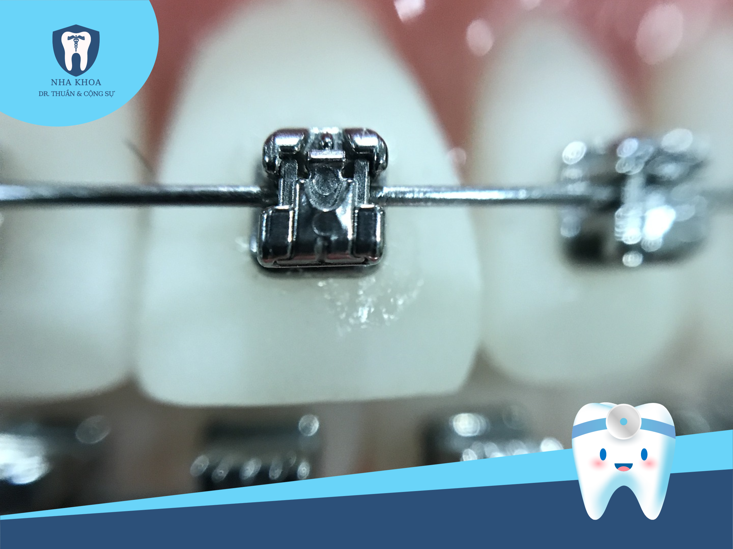 mac-cai-tu-buoc-va-mac-cai-thuong-1