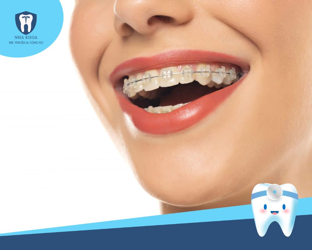 niềng răng mắc cài sứ bao nhiêu tiền