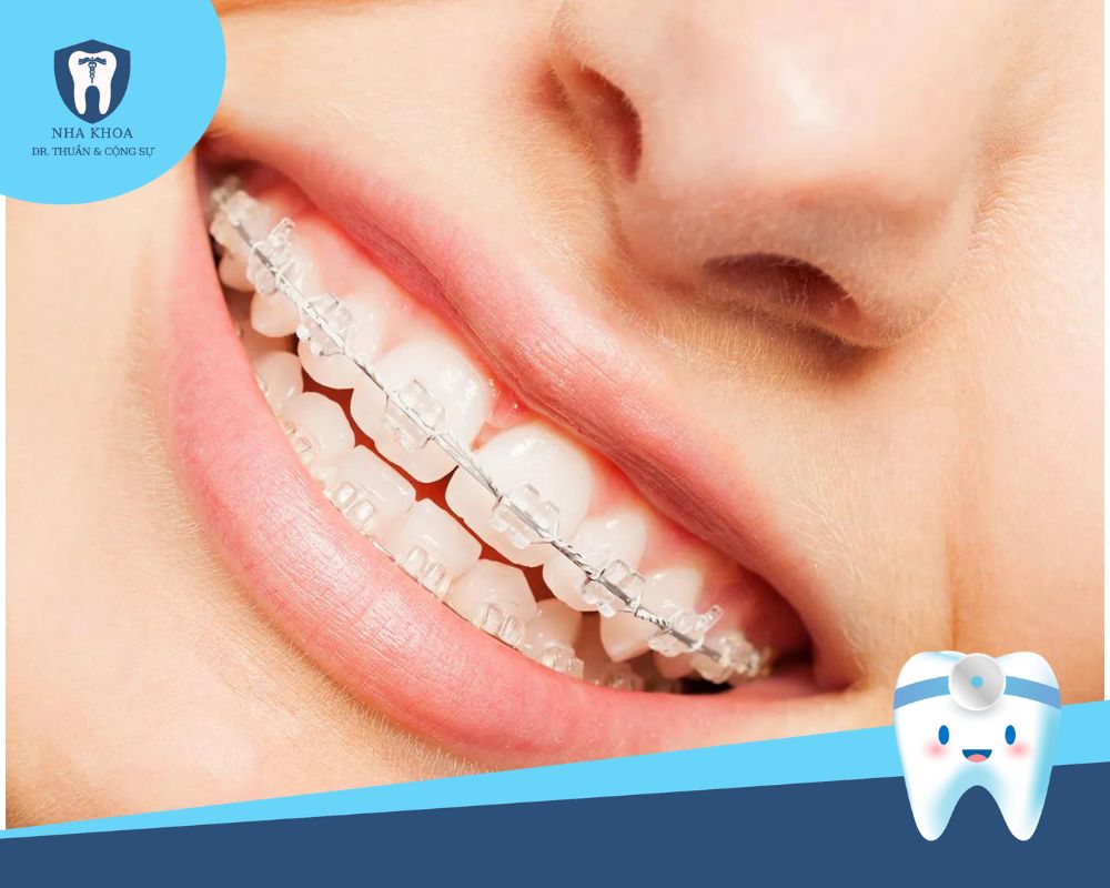 niềng răng mắc cài sứ