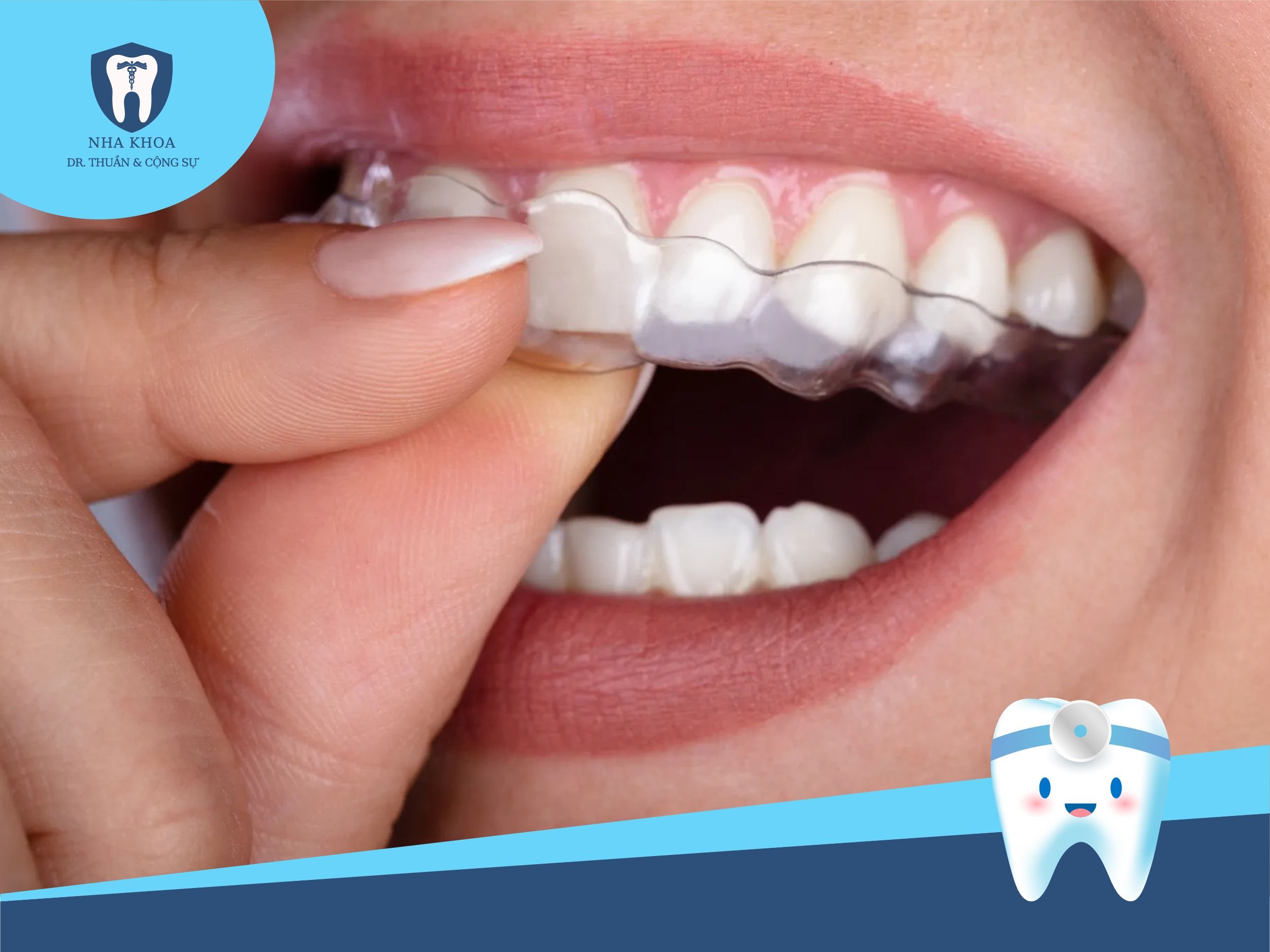 Lưu ý khi niềng răng Invisalign