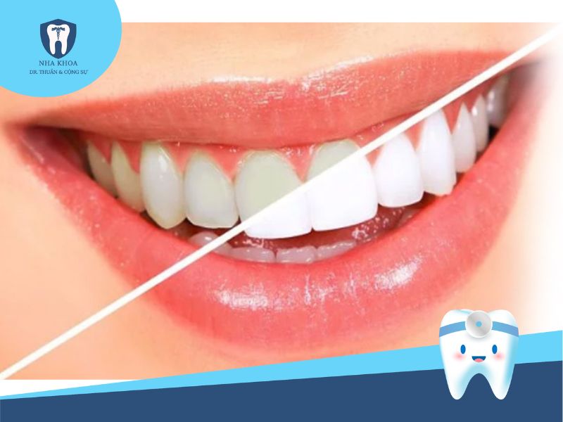 tẩy trắng răng laser